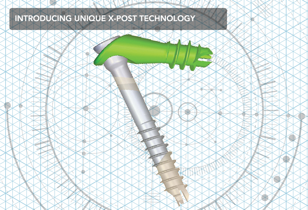 The original system for Intra-Osseous Fixation. IO Fix Classic