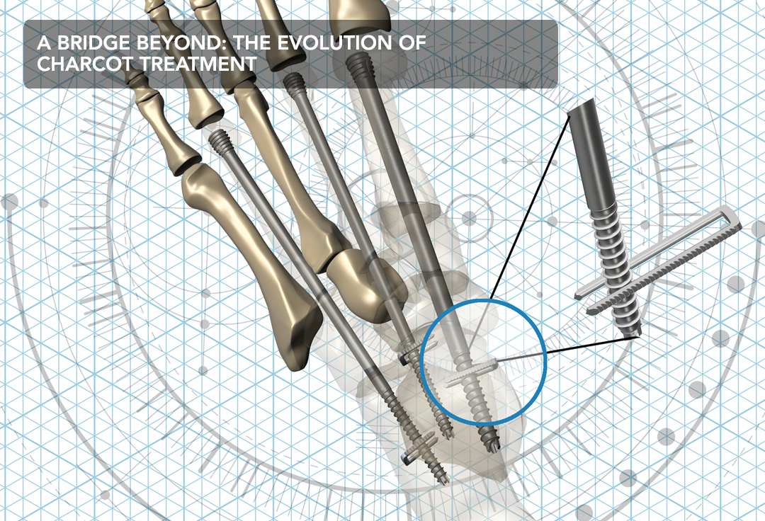 A SuperconstructTM designed to go beyond the normal principles of orthopedics in order to improve stability in the Charcot patient Axis Charcot Fixation System