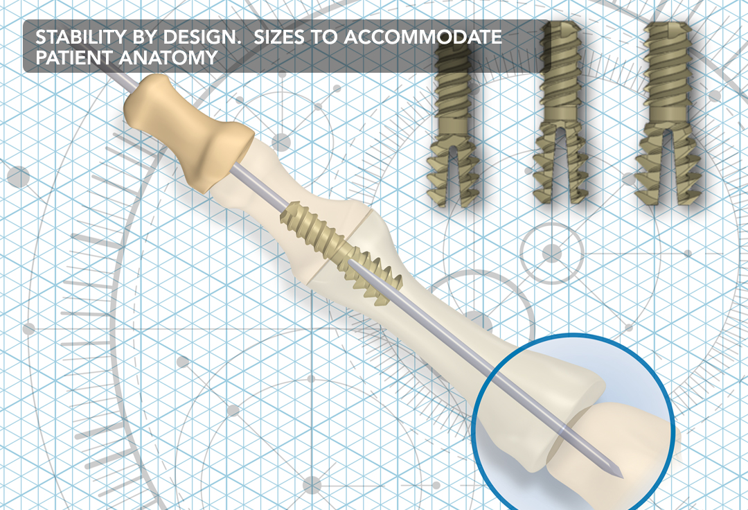 Allows simultaneous use of intramedullary pin for fixation of MTD joint when necessary. HammerFIX
