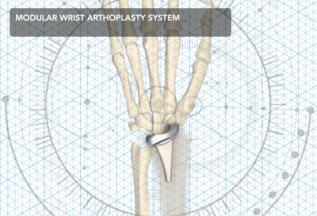 Modular Wrist Arthoplasty System