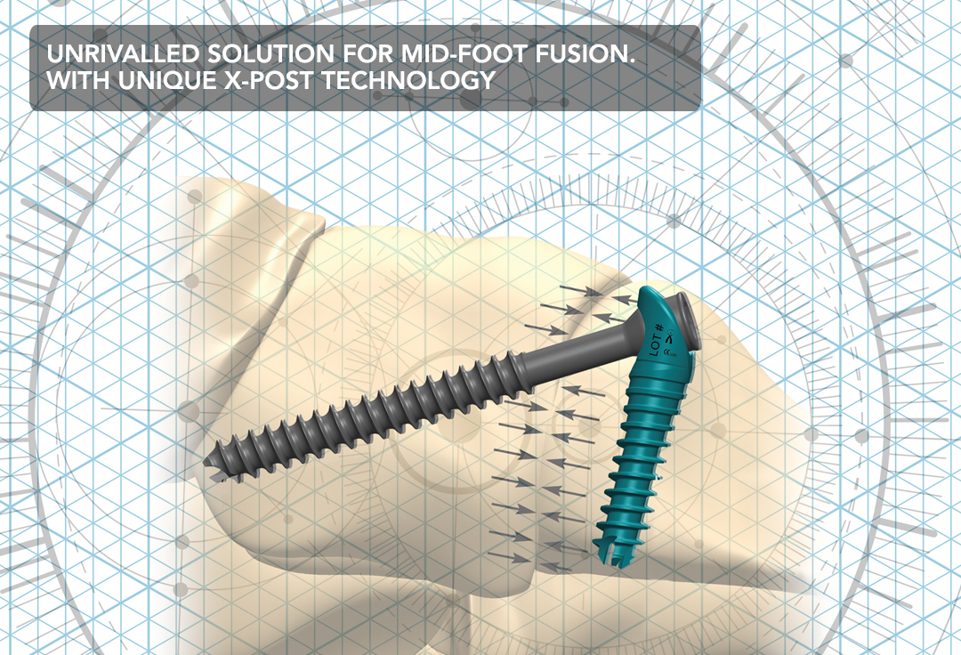 Unique X-Post technology delivers compressive forces across a greater surface area. IO FiX 2.0 Unrivaled Solution for Mid-foot Fusion with unique x-post technology