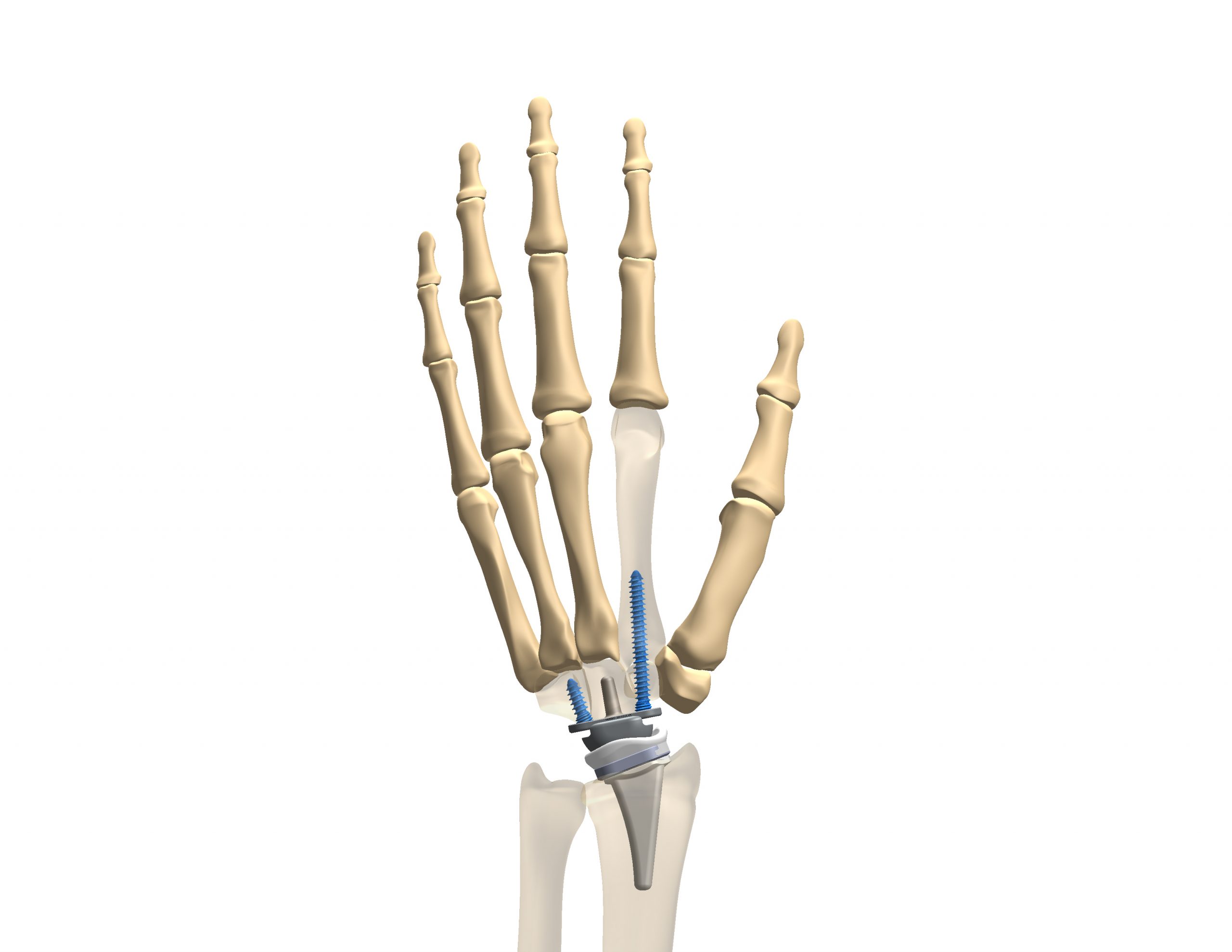 kinematx-total-wrist-front-view kinematx-total-wrist-front-view