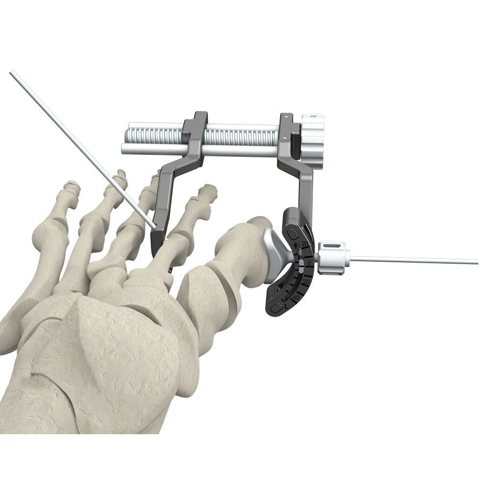 Freedom Lapidus Joint Preparation & Alignment System