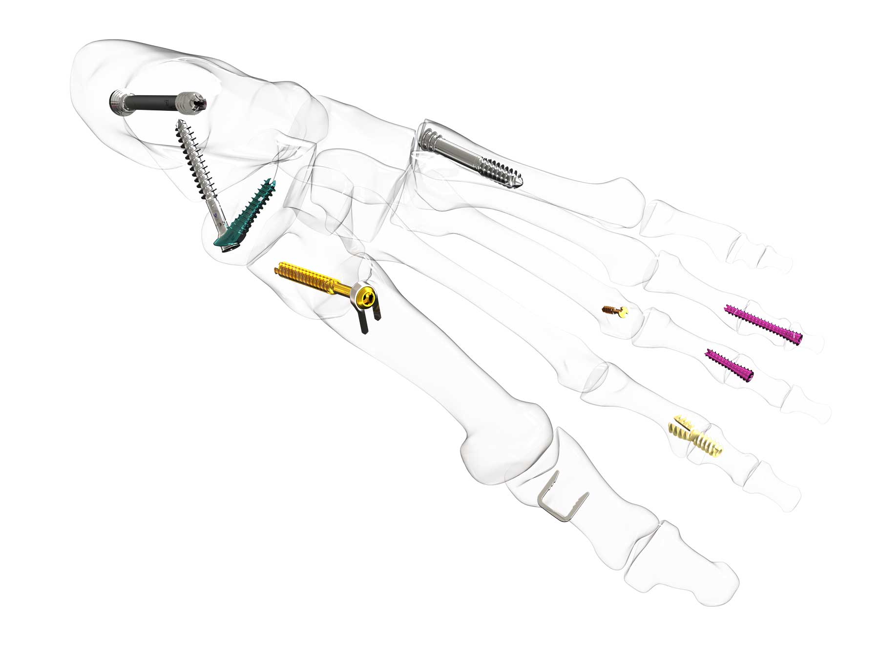 Intraosseous-Model